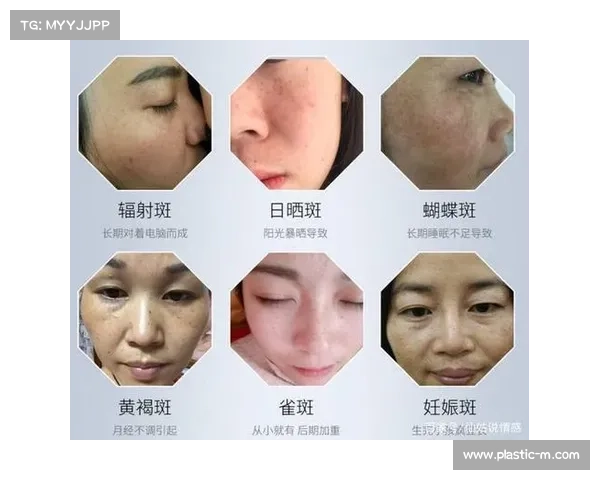 辐射斑治疗指南:有效方法揭秘 辐射斑治疗指南:有效方法揭秘